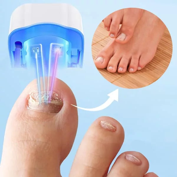 Laser para hongos
